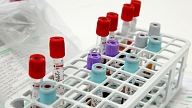 Biedrība: Šogad HIV pacientiem valsts apmaksātu terapiju sāks ātrāk