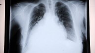 Rīgā notiks Pasaules Tuberkulozes dienai veltīti izglītojoši pasākumi