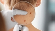 10 populāri mīti un patiesība par melanomu: Stāsta dermatologs