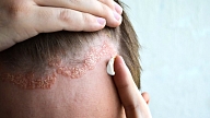 Atopiskais dermatīts – slimība, kas nenogalina, bet atņem dzīvei kvalitāti

