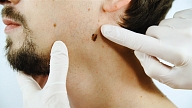 Dermatologs: "Ja melanoma tiks atklāta vēlās stadijās, no tās gada laikā nomirs tikpat daudz cilvēku kā no Covid-19"

