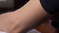 Kas ir keratosis pilaris un kā ar to labāk sadzīvot? Skaidro speciālisti