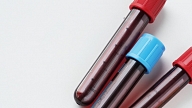 Laboratorija: Analīžu nodošanai ir pieejama laboratorijas māsas vizīte mājās