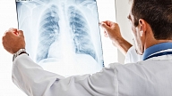 Plaušu emfizēma: Cēloņi, simptomi, ārstēšana

