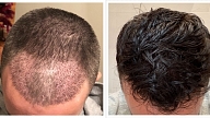 Uzlabojiet dzīves kvalitāti ar matu transplantāciju klīnikā Rubenhair

