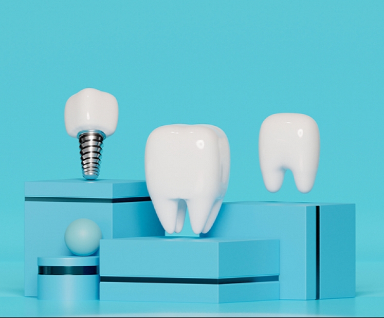 Biežākie mīti par zobu implantoloģiju – skaidro veselības un skaistuma centra Adoria eksperti