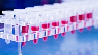 Hematoloģe: Asins vēža ārstēšanai jāpanāk labāka diagnostika un jaunākās paaudzes zāļu pieejamība