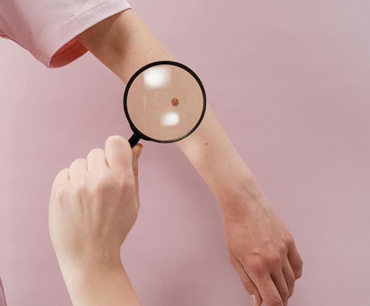 Melanomas ārstēšanā vājie posmi – diagnostika un zāļu kompensācija 