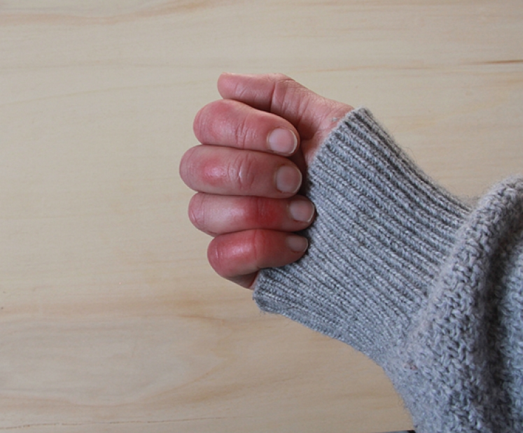 Smagi apsaldējumi ziemā: Austrumu slimnīcas ārsti aicina pasargāt seniorus un sevi