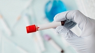 Profesore: Laboratoriski pozitīvi vīrushepatīta C antivielu rezultāti ir konstatēti salīdzinoši bieži