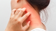 Eksperti: Atopiskā dermatīta pacientu diskriminācija ir jānovērš