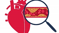 Kā uzveikt augstu holesterīnu 21. gadsimtā? Stāsta kardioloģe