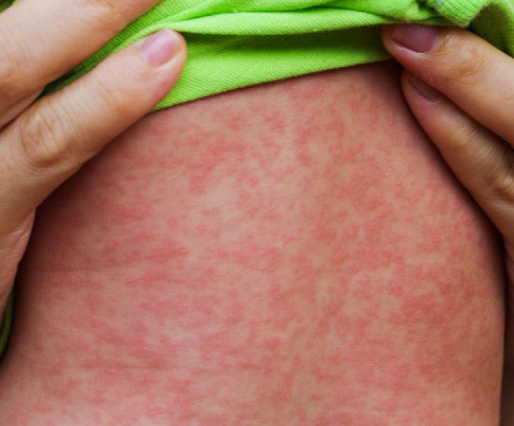 SPKC: Latvijā reģistrēts pirmais masalu uzliesmojums kopš 2018. gada