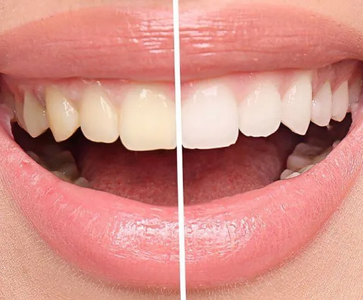 Zobu balināšana, terapija un mīti: kas patiesībā notiek ar tavu smaidu?