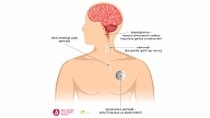 Bērnu slimnīcā paplašinātas iespējas ārstēt pacientus ar epilepsiju
