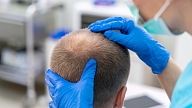 Plikpaurība un matu izkrišana vīriešiem: Kā to risināt?