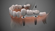 Regulāras vizītes pie zobārsta – visefektīvākā zobu slimību profilakse