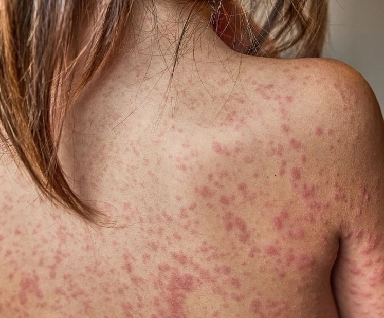 SPKC: masalu izplatīšanās turpinās, jāpārbauda bērnu vakcinācijas statuss