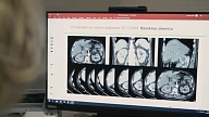 "Ja būtu citā valstī, es izdzīvotu": Video vēstījumā vērš uzmanību uz kritisko finansējumu vēža ārstniecībā