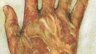 EKZĒMA