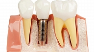 Tendences zobu implantātu jomā 2017. gadā