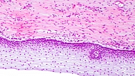 Histoloģisko izmeklējumu nozīme dzemdes kakla vēža diagnostikā 