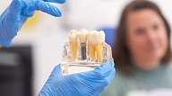 Zobu implantācija. Kad nepieciešams zobu implants un kā norit ārstēšana?