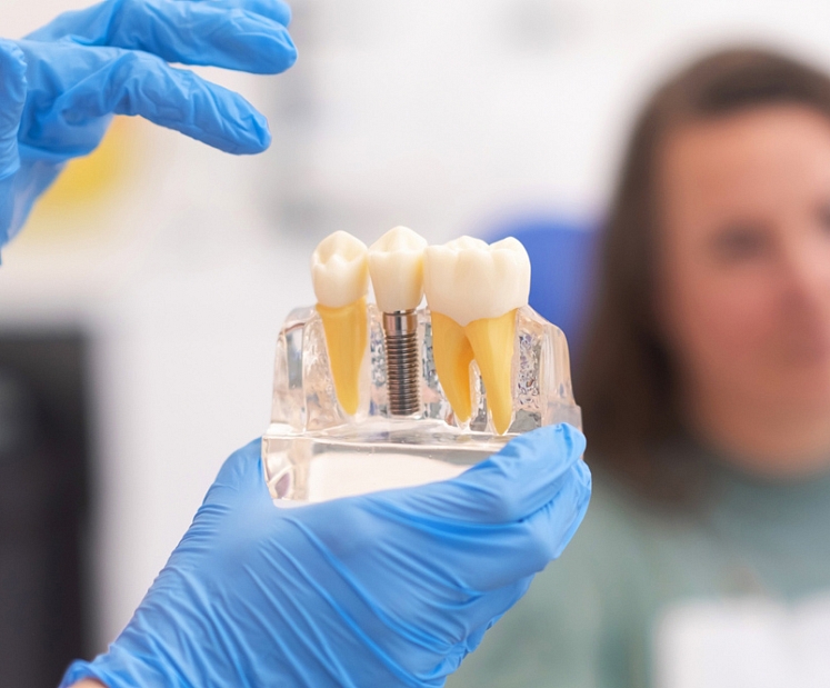 Zobu implantācija. Kad nepieciešams zobu implants un kā norit ārstēšana?