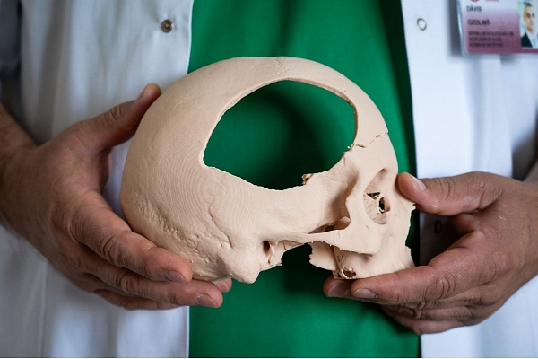 3D tehnoloģijā modelētais galvaskauss ar traumas dēļ bojāto un pēc tam izņemto fragmentu.