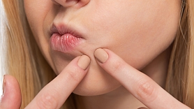 Kā palīdzēt pusaudzim tikt galā ar akni? Praktiski padomi vecākiem