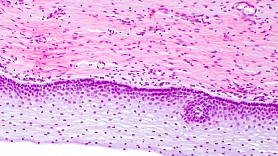 Histoloģisko izmeklējumu nozīme dzemdes kakla vēža diagnostikā 