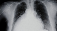 Asociācija: Smacējošais bronhīts Latvijā ir maz diagnosticēts, tomēr ar to slimo apmēram 15% iedzīvotāju virs 40 gadiem
