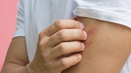 Alerģiska ādas nieze un citas ādas reakcijas: Kā rīkoties?

