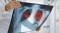 Pacients: Plaušu audzējs nav spriedums – mūsdienīgi medikamenti ļauj dzīvot un strādāt

