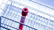 Hematologi aicina – asins analīzes ne tikai jānodod, bet arī jāseko līdzi rezultātiem!