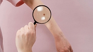 Melanomas ārstēšanā vājie posmi – diagnostika un zāļu kompensācija