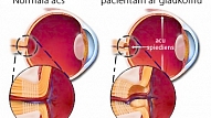 Agrīna diagnostika – labākais līdzeklis pret glaukomu