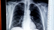Akcijas laikā plaušu veselības pārbaudēs atklāj saslimšanas