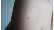 Mediķi aicina iedzīvotājus bez maksas pārbaudīt ādas veidojumus