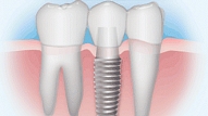 Kas ir zobu implanti jeb zobu mākslīgās saknes?