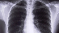 Latvijā pieaugusi saslimstība ar tuberkulozi