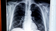 SPKC: Saslimstība ar tuberkulozi turpina samazināties