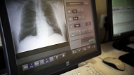 Vai Latvijā izdosies uzveikt tuberkulozi? Skaidro eksperte