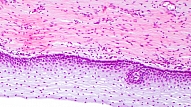 Histoloģisko izmeklējumu nozīme dzemdes kakla vēža diagnostikā 