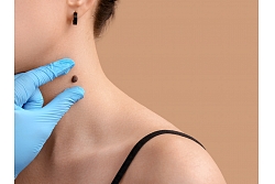 Ādas veidojuma (dzimumzīmes) profesionāla novērtēšana kakla zonā dermatologa kabinetā.