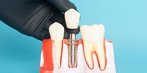 Zobu implanti – risinājums uz mūžu?