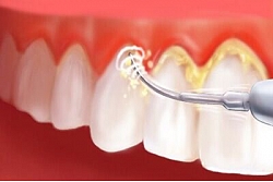 Aplikuma un zobakmens noņemšana