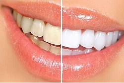 Lekcijas par zobu kopšanu